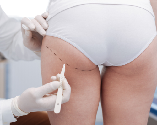 gluteoplastica